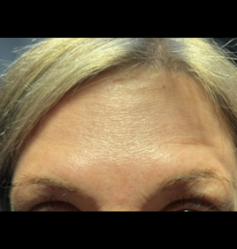After photo of woman's forehead with no wrinkles