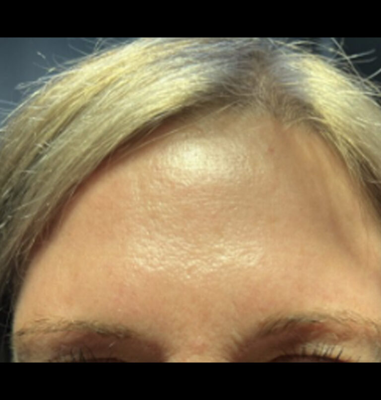 After photo of woman's forehead and eyebrows without wrinkles