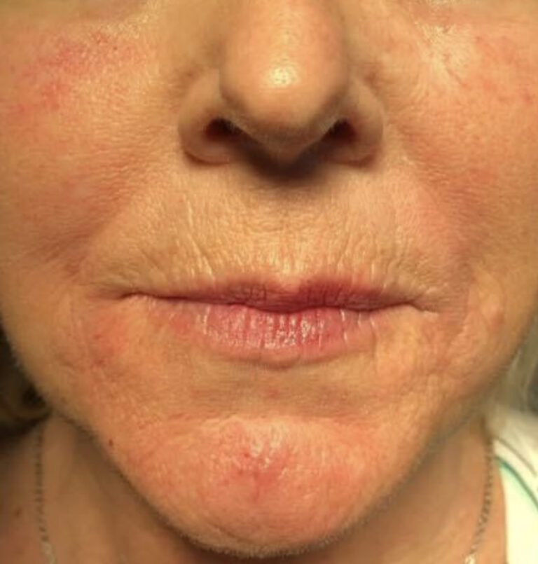 Close-up of older woman's mouth area after filler
