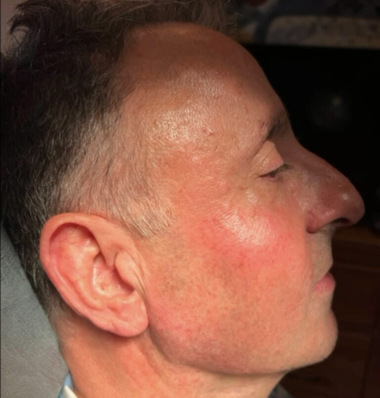 Photo of man's facial profile after jawline rejuvenation