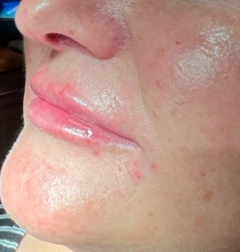 Close up of woman's lips after lip filler