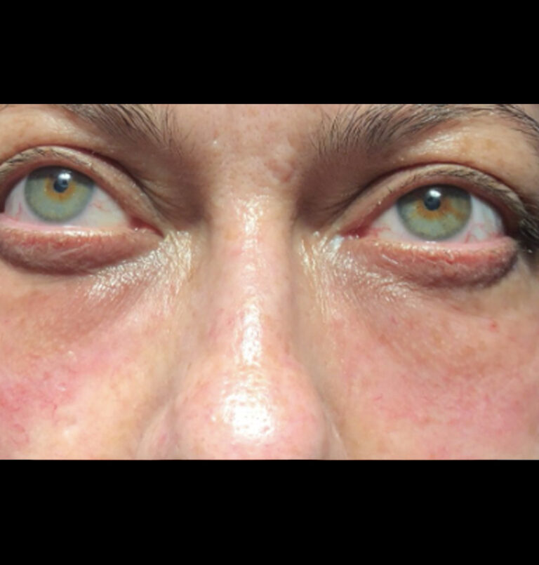 Close up of woman's eyes after tear trough filler