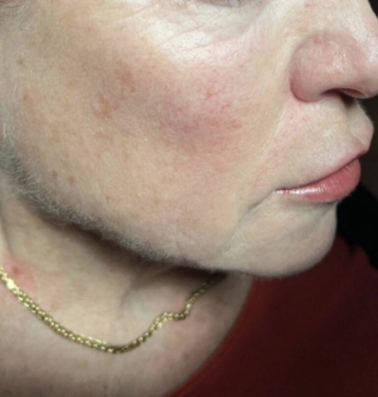 Close up of woman's jawline after ultherapy treatment