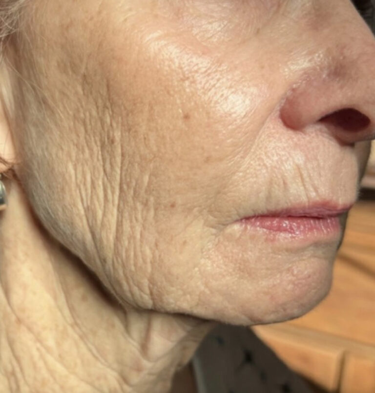 Close up of older woman's face after ultherapy treatment