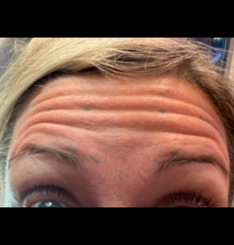Before photo of woman's forehead wrinkles