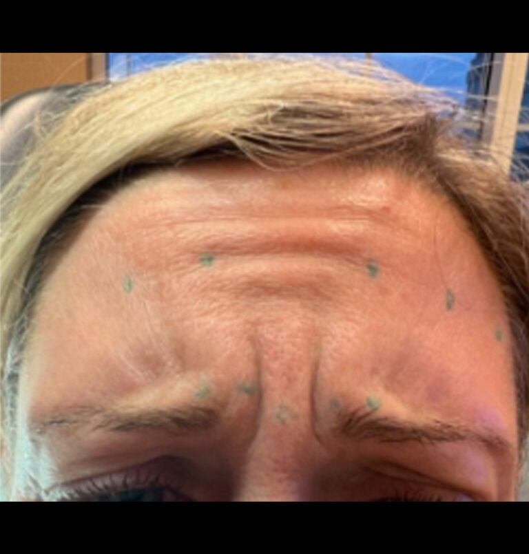 Before photo of woman's forehead and eyebrows with wrinkles