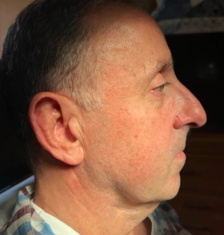Photo of man's facial profile before jawline rejuvenation