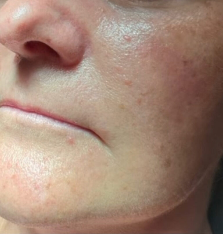 Close up of woman's lips before lip filler
