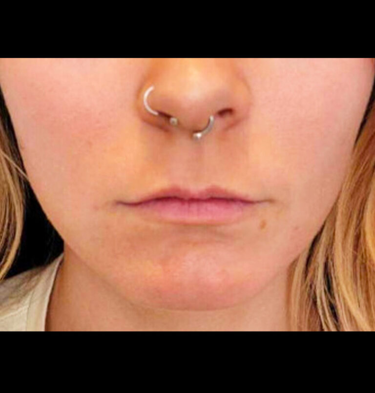 Close up of young woman's lips before lip filler