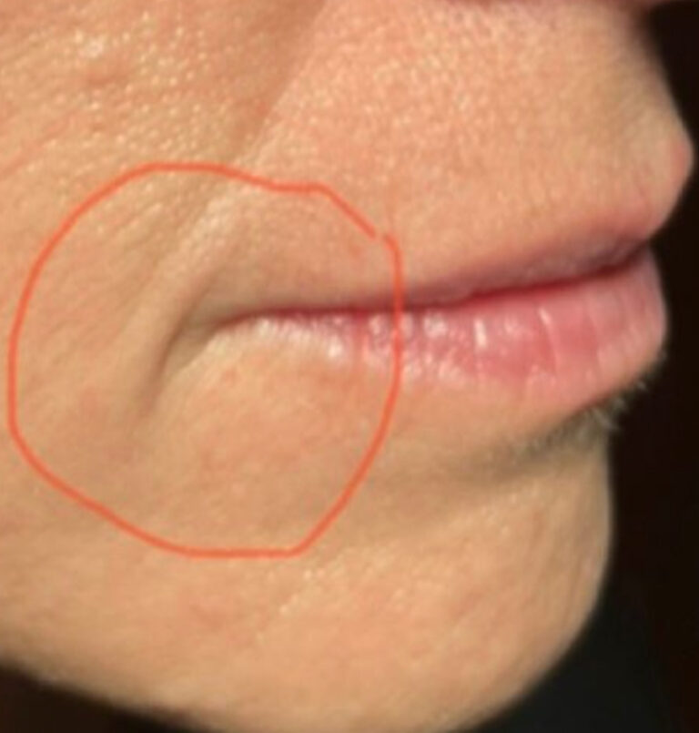 Close up of the corner of a person's mouth before redensity filler