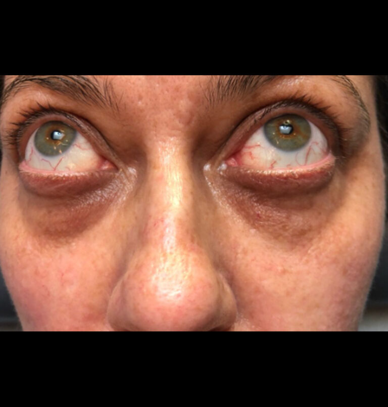 Close up of woman's eyes before tear trough filler