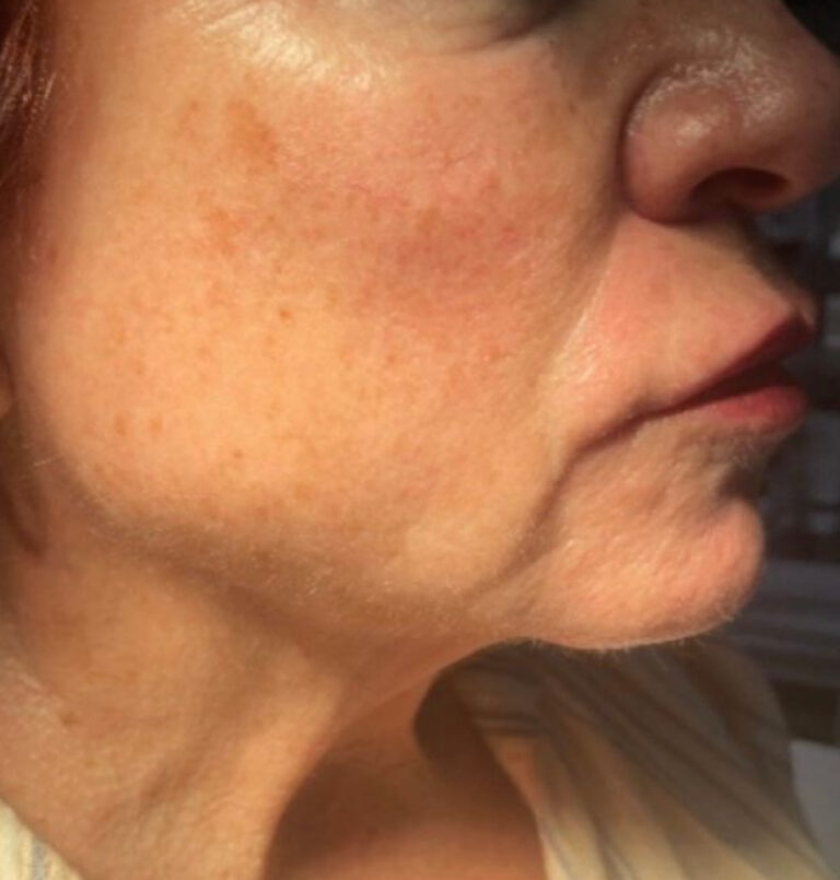 Close up of woman's jawline before ultherapy treatment