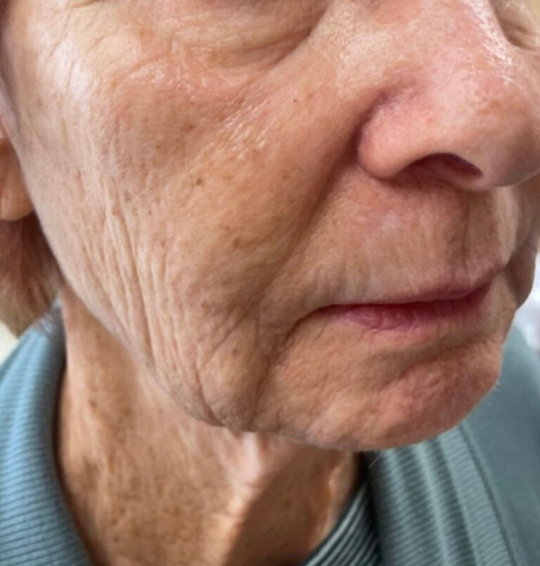 Close up of older woman's face before ultherapy treatment