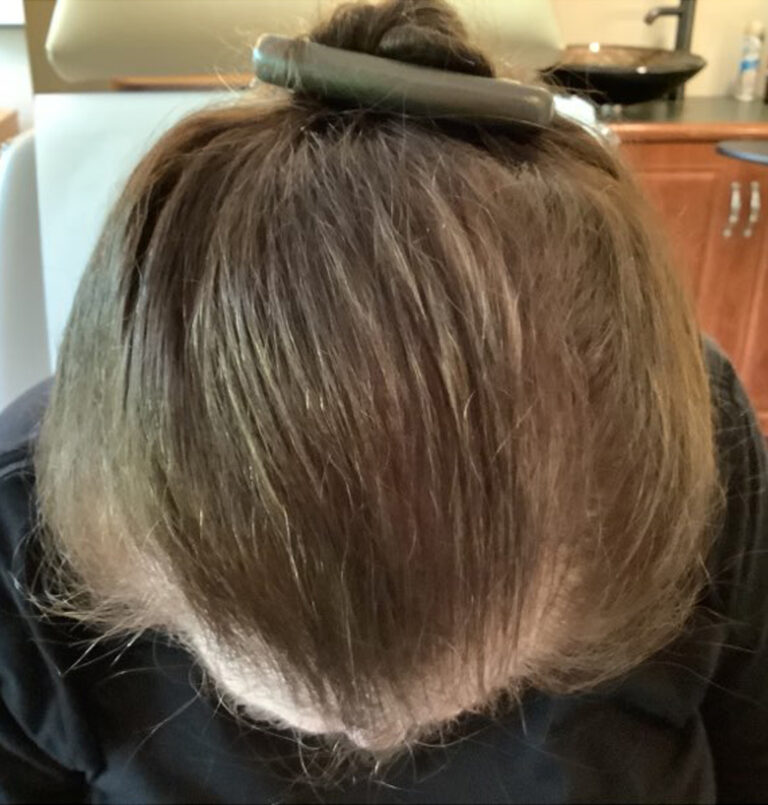 Photo of the top of someone's head after hair loss treatment