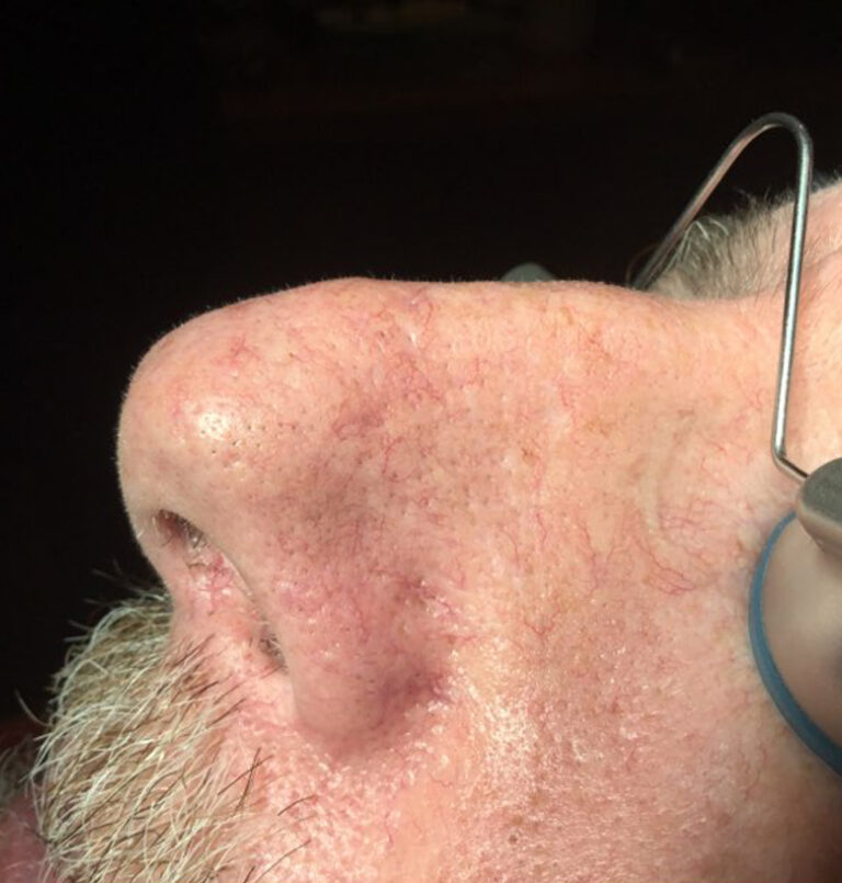 Close up of man's nose after laser treatment