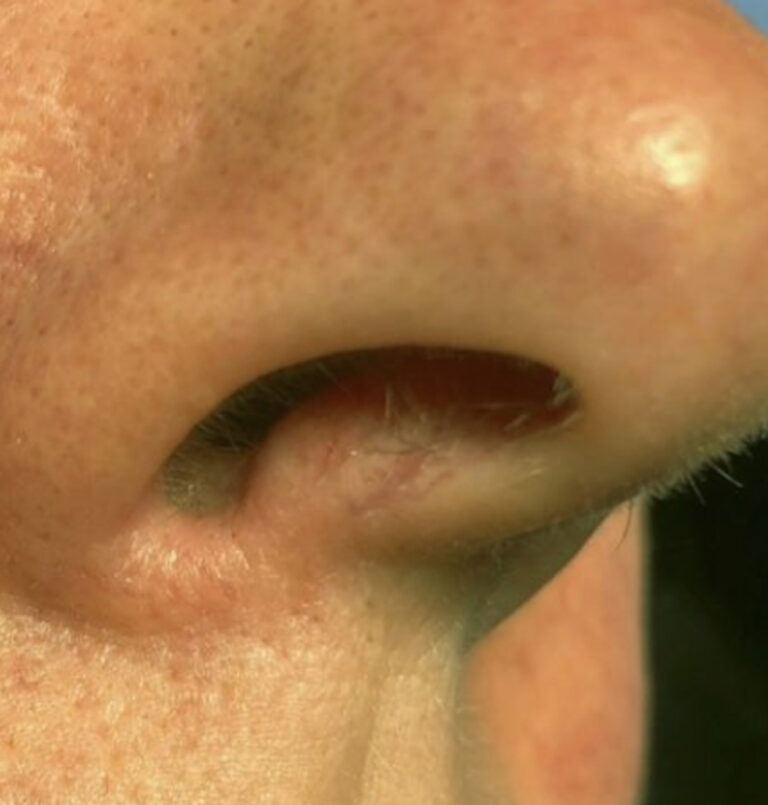 Close up of person's nostril after laser treatment