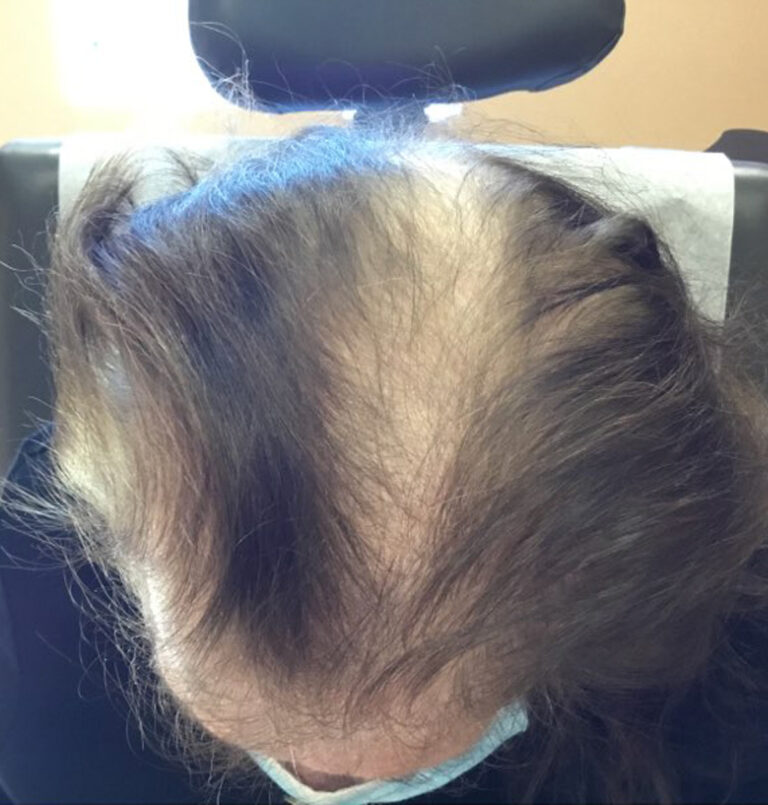 Photo of the top of someone's head with hair loss