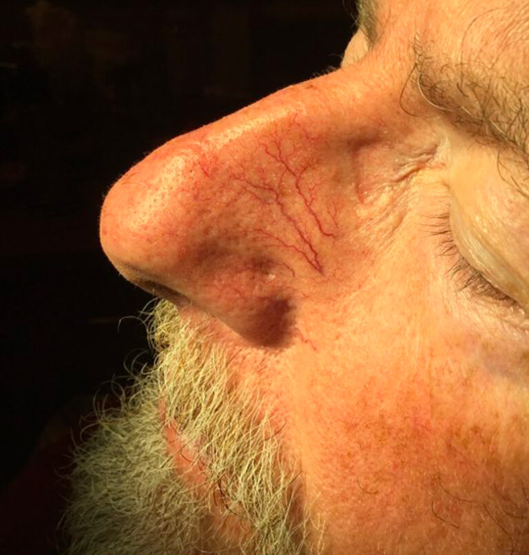 Close up of man's nose before laser treatment