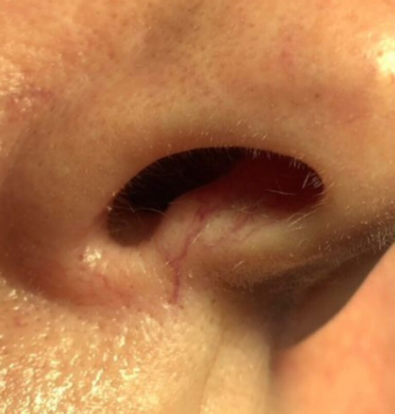 Close up of person's nostril before laser treatment