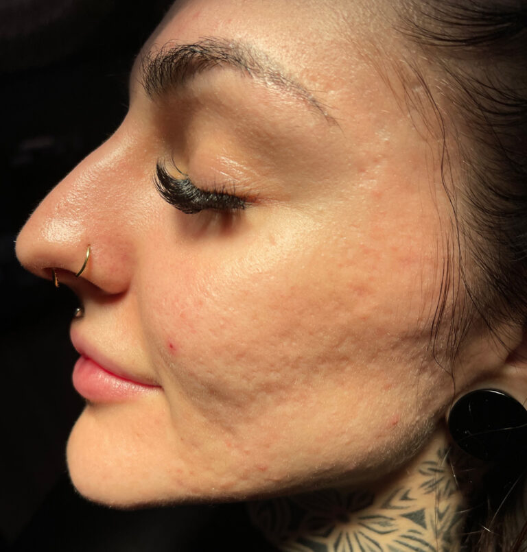 Photo of woman's facial profile before micro needling