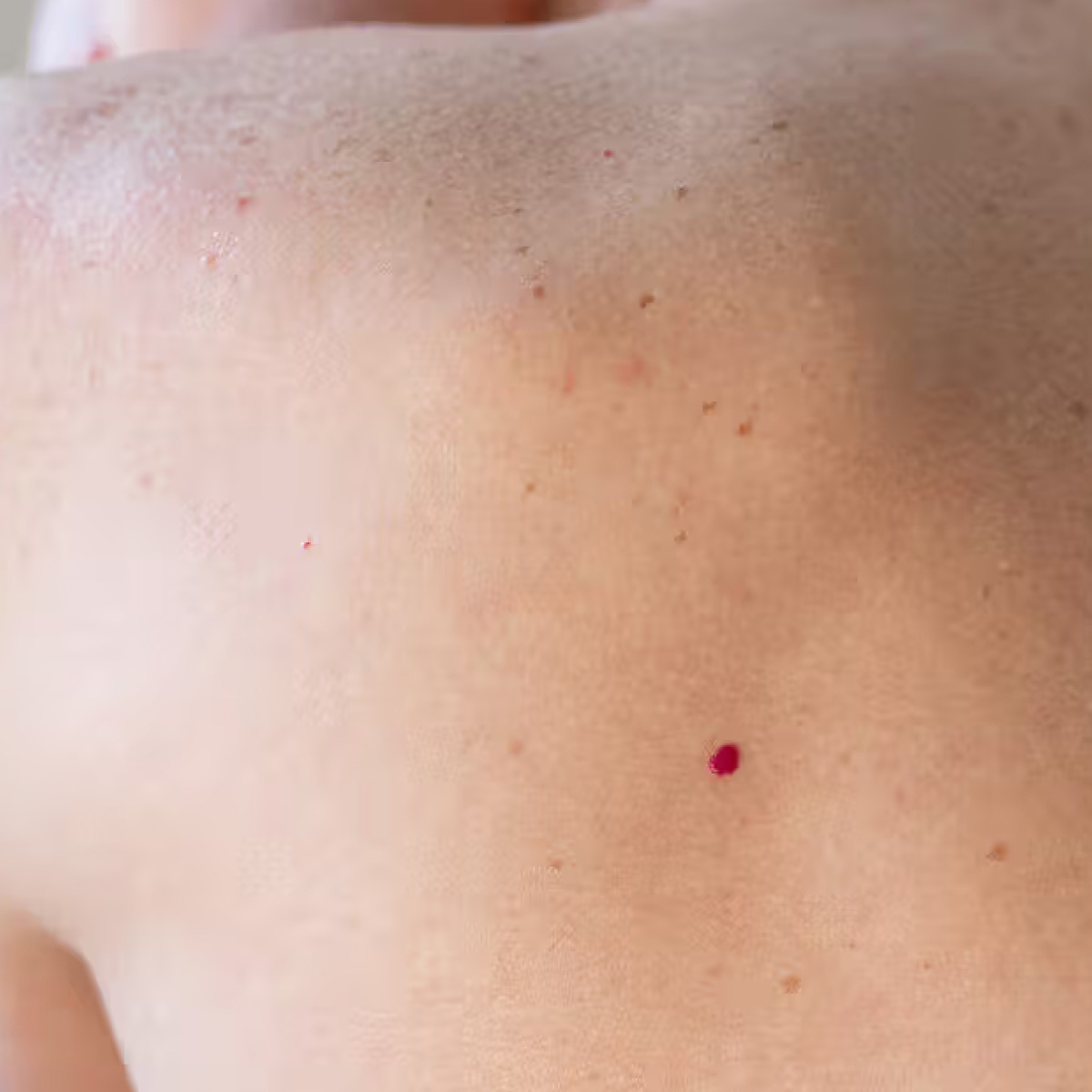 Photo of a person's back with cherry angioma