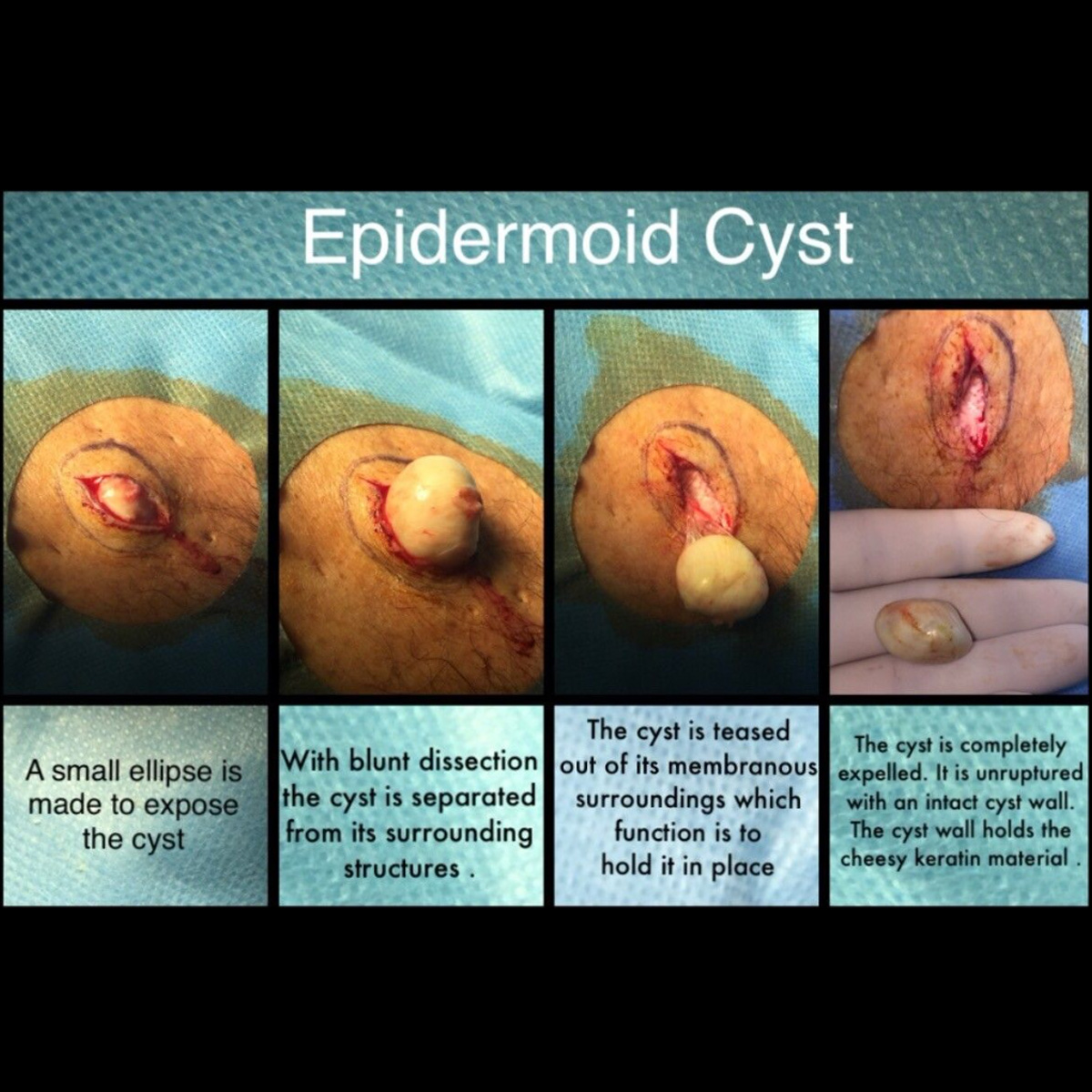 4-image diagram showing the removal of a epidermoid cyst