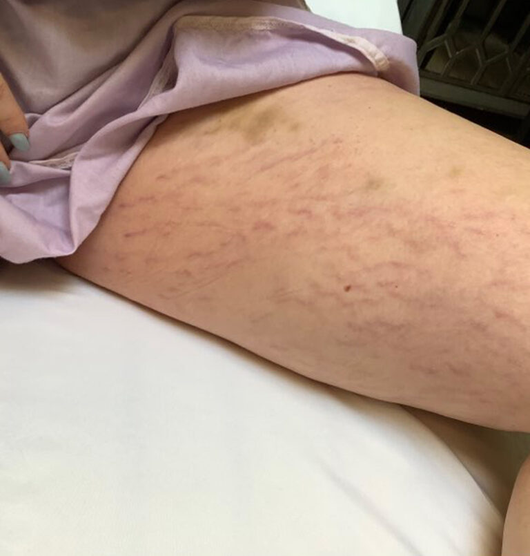 Close up of person's inner thigh before Vi Peel chemical peel treatment
